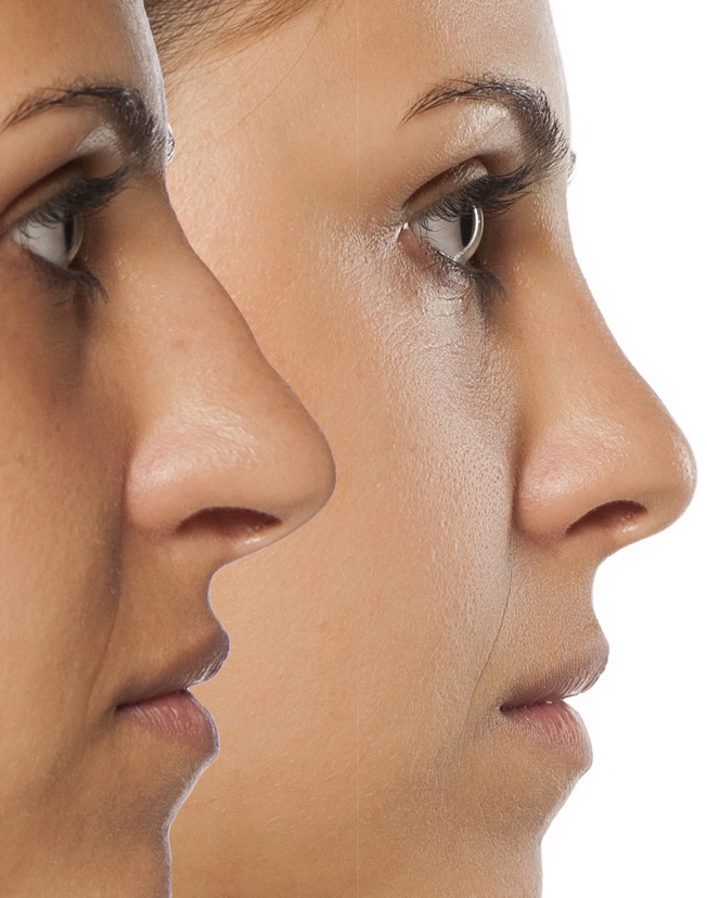 rhinoplastie médicale centre le phénix pamiers docteur nicolazic