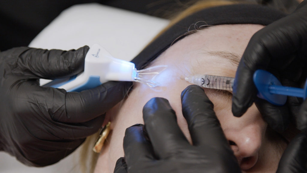 injection acide hyaluronique au Centre esthétique Le Phenix en Ariège