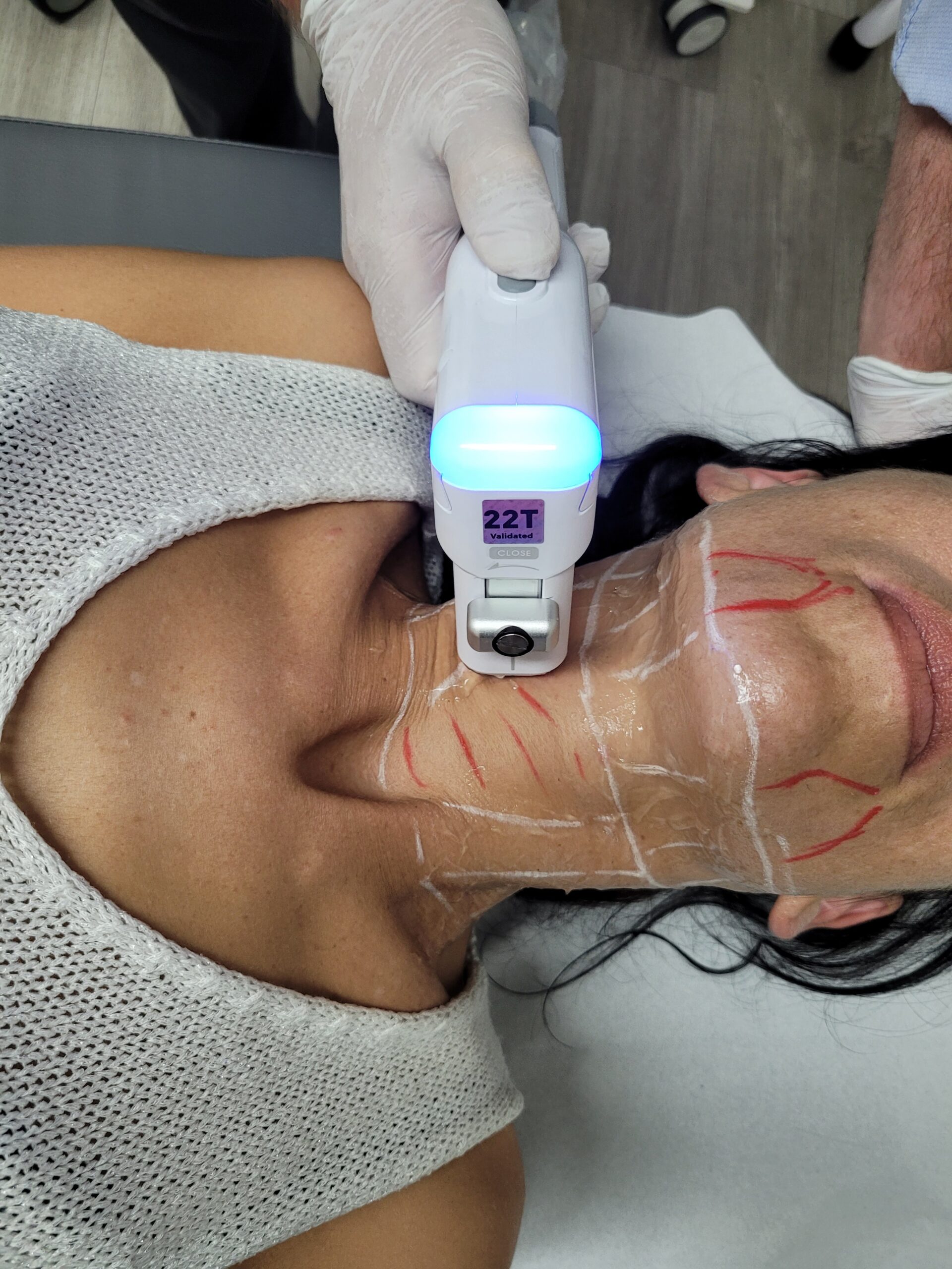 Acné et cicatrices d'acné au Centre Laser et Esthétique Le Phénix à Pamiers