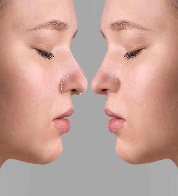 rhinoplastie